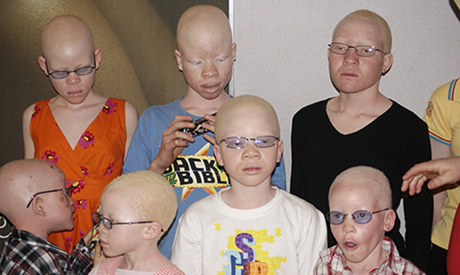 Sunscreen for people living with albinism